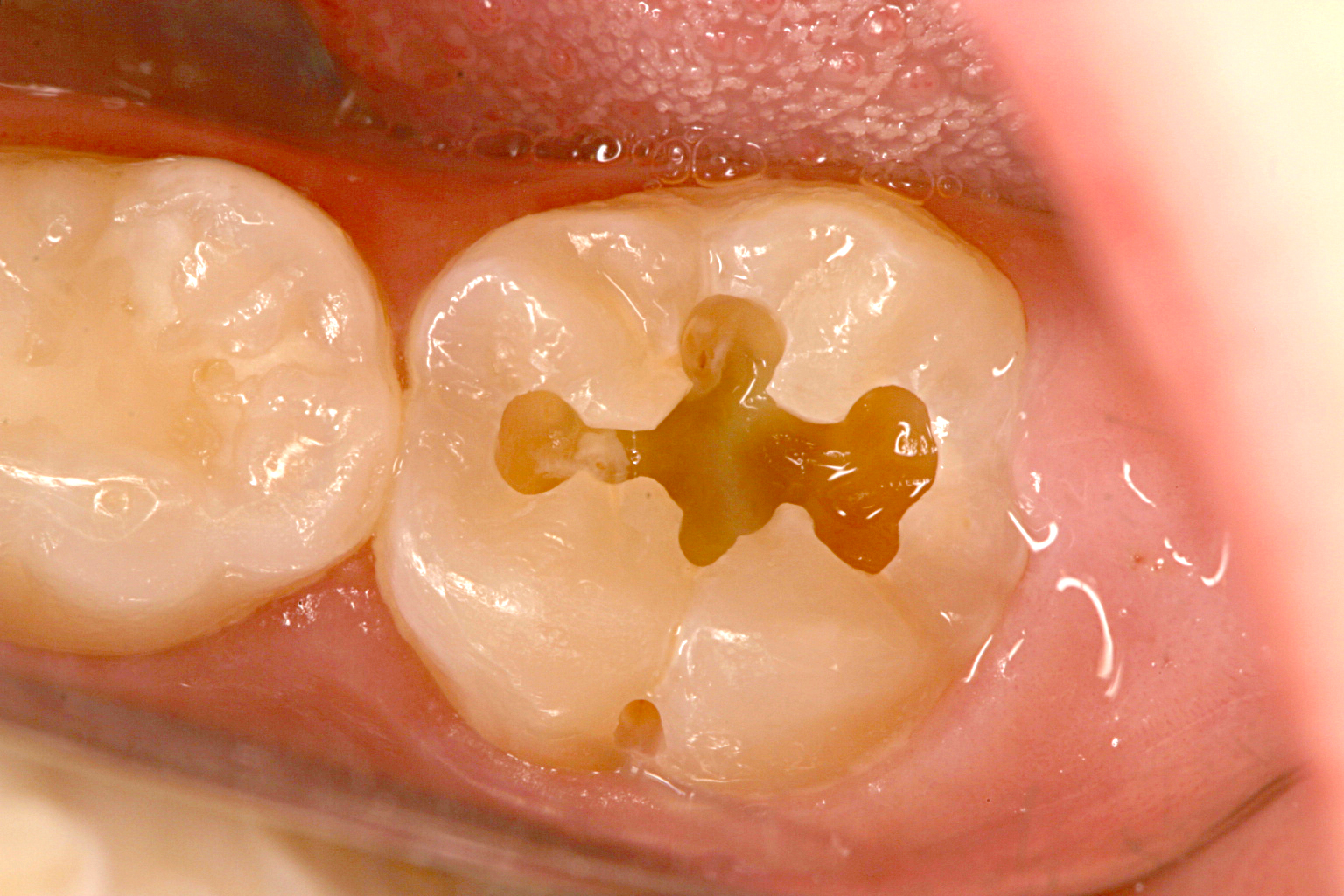 虫歯をなおすって？のイメージ