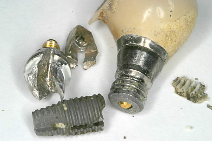 インプラントのの写真